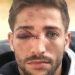 Photo: L’impressionnante blessure au visage de Teddy Iribaren