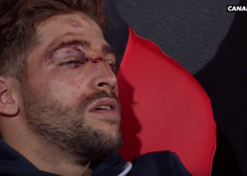 Vidéo: L’impressionnante blessure au visage de Teddy Iribaren