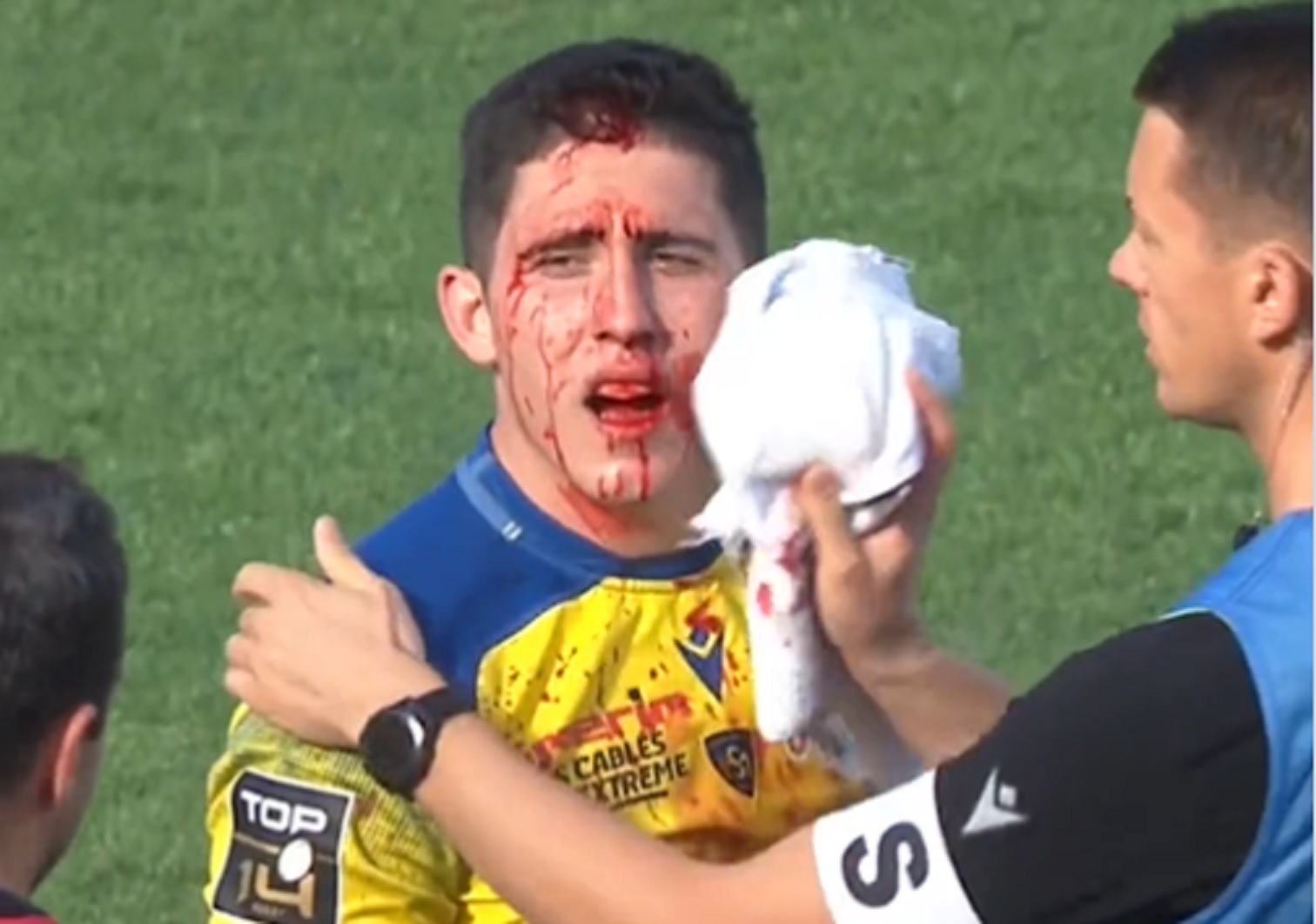 VIDEO : Anthony Belleau se retrouve en sang !